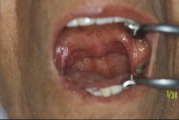 口腔ケアの症例10