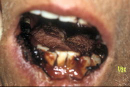 口腔ケアの症例1